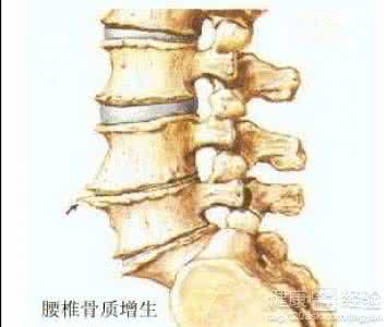 治疗腰椎骨质增生偏方 外科偏方 腰椎骨质增生偏方