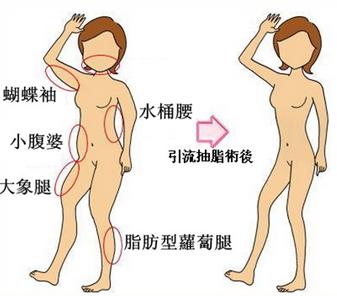 抽脂减肥价格表 抽脂减肥价 抽脂减肥价格