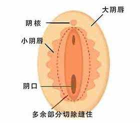小阴唇肥大整形价格 阴唇肥大整形 三个整形方案 解决小阴唇肥大