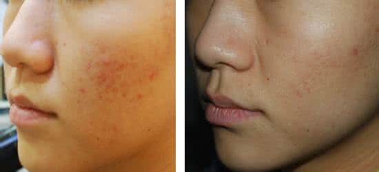 如何祛痘痕去痘印 祛痘印 祛痘痕