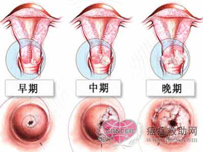 宫颈癌患者吃什么好 宫颈癌吃什么 宫颈癌患者要补充四种营养物质