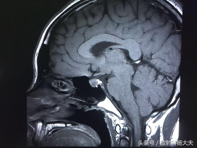 38岁女性停经，不是怀孕，大夫查完妇科，为啥要做头部MRI?