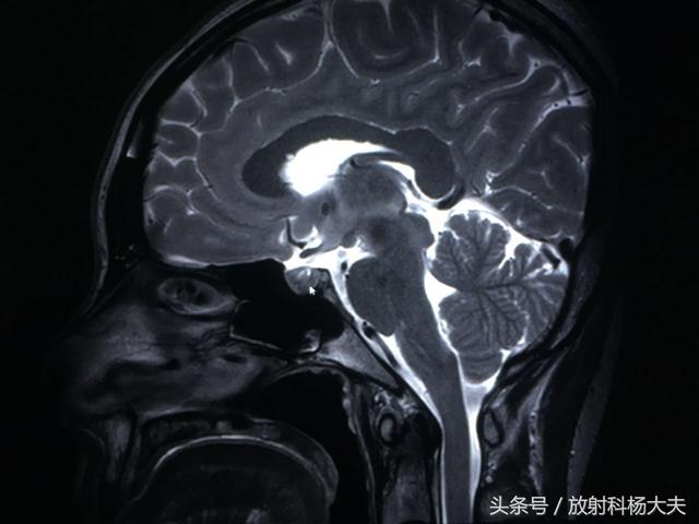 38岁女性停经，不是怀孕，大夫查完妇科，为啥要做头部MRI?